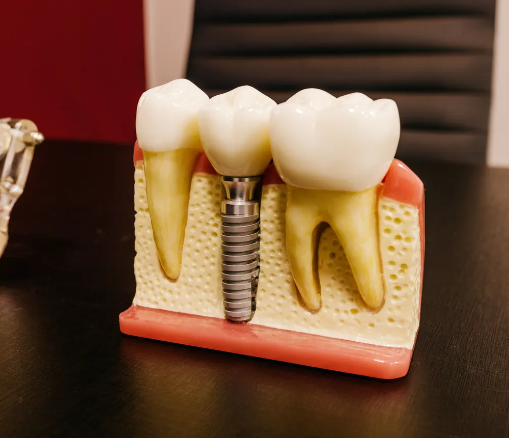 Maqueta de implante dental para explicar la cirugía maxilofacial al paciente